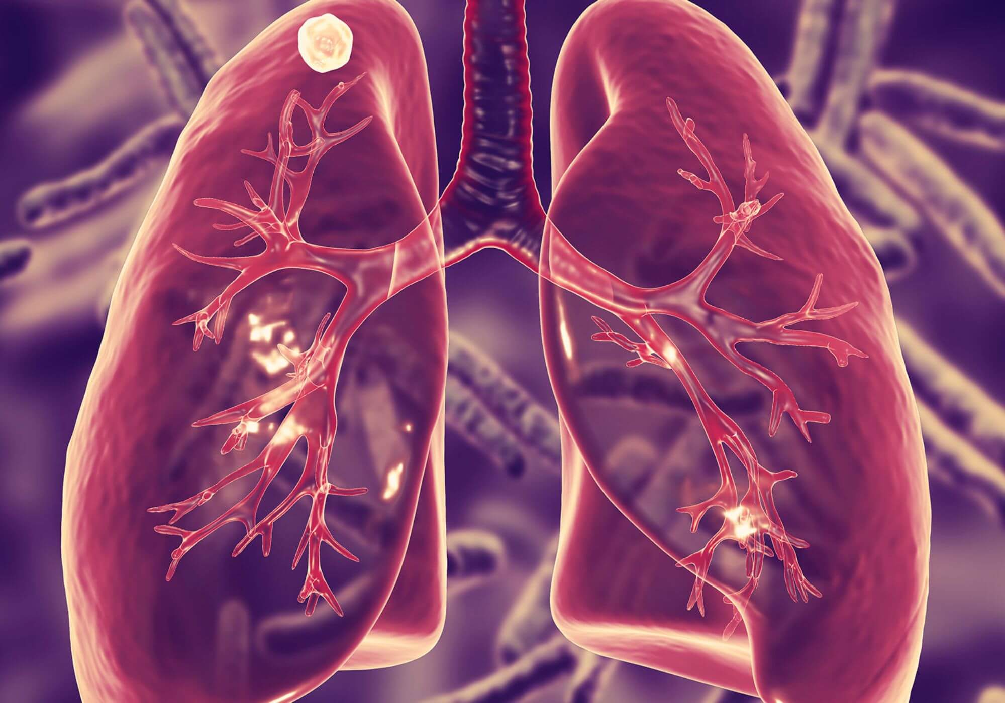 TUBERCULOSIS