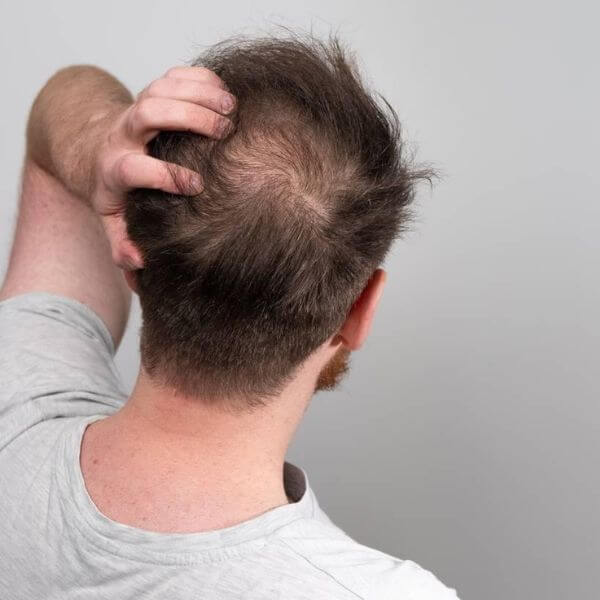 Male Pattern Baldness