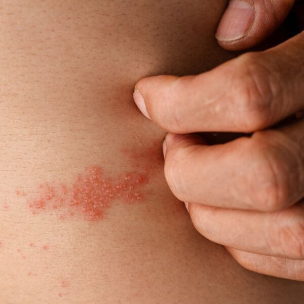 bacterial skin infections
