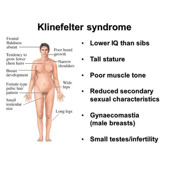 Hidden causes of erectile dysfunction-Klinefelter syndrome 