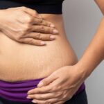 Collagen Crisis: The Hidden Cause of Stretch Marks