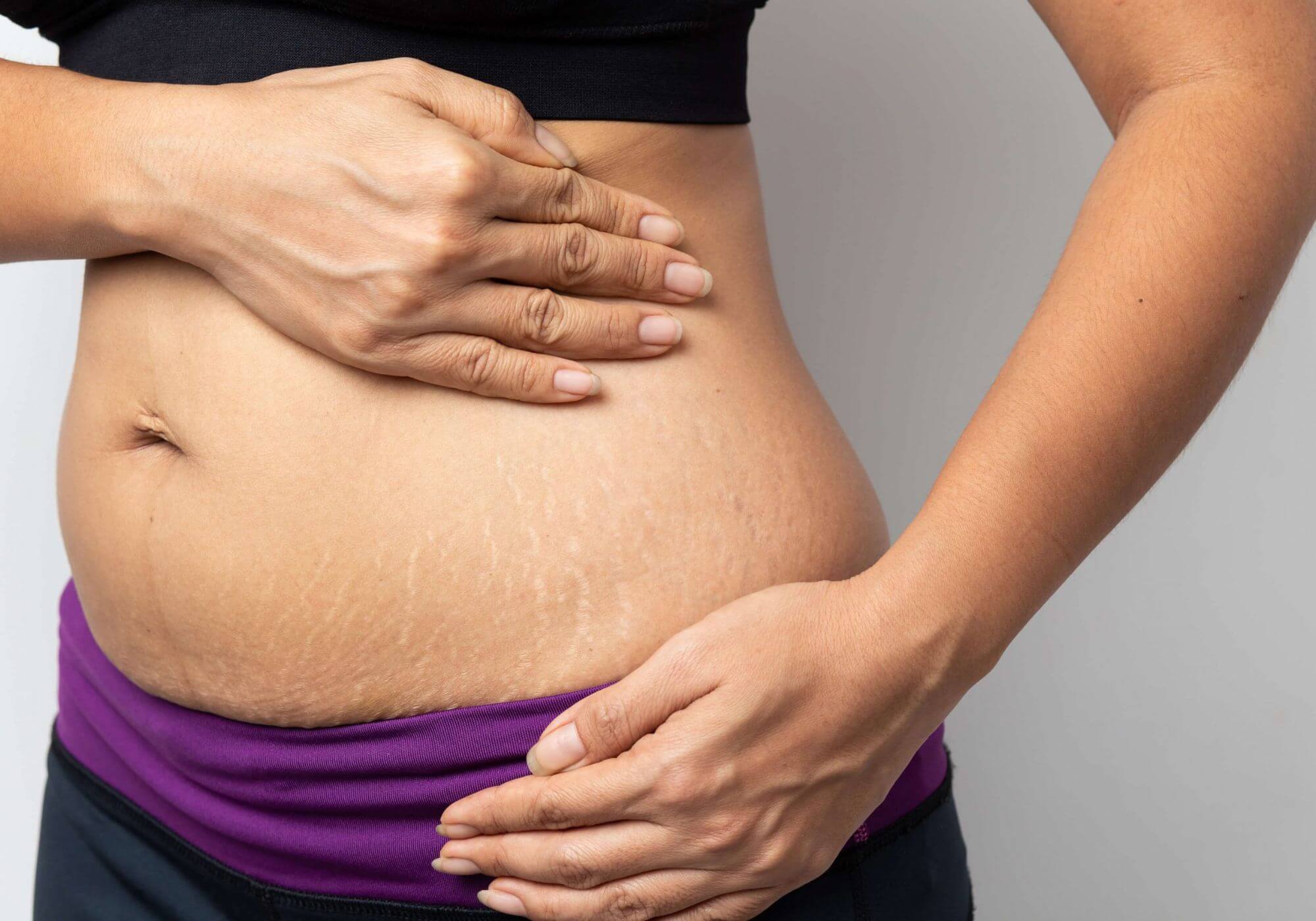 Collagen Crisis: The Hidden Cause of Stretch Marks