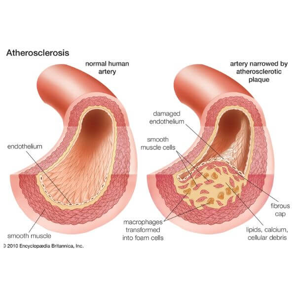 Atherosclerosis 